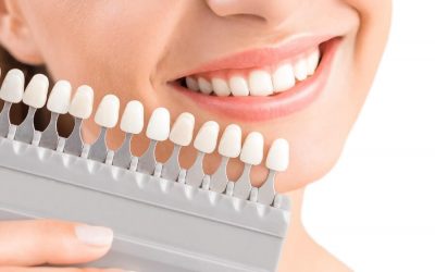 Why Professional Tooth Whitening in Webster Provides Better Results than Over-The-Counter Whitening Products