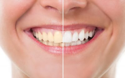 Natural Tooth Whitening – Fact or Fiction?