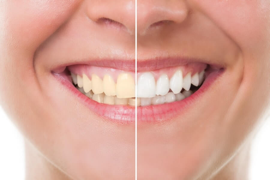 Natural Tooth Whitening - Fact or Fiction