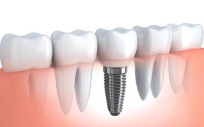 Should I Replace An Extracted Tooth With A Dental Implant?