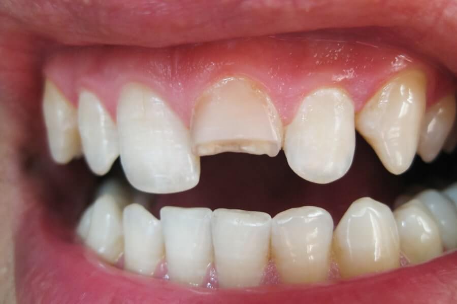 Broken Tooth Repair – Why Are My Teeth Breaking