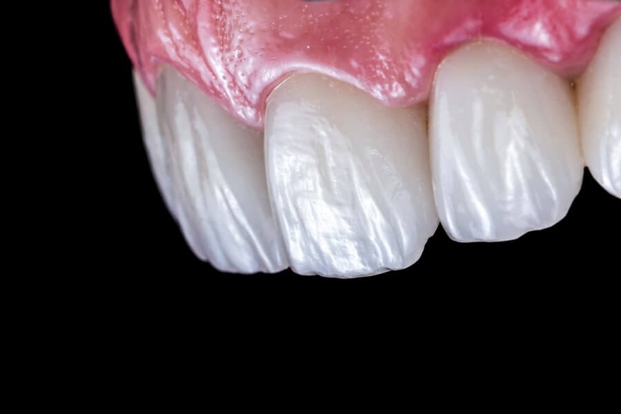 Can You Get Cavities with Porcelain Veneers Tips for Maintaining Porcelain Veneers in Webster