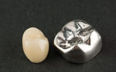 How Long Do Dental Crowns Last?