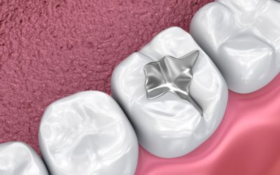 Foods to Avoid After Dental Sealants