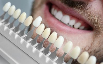 How to Keep Veneers from Staining