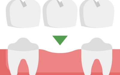 What Are the Benefits of Dental Bridges?