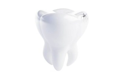 My Front Tooth Cracked — Can It Be Fixed?