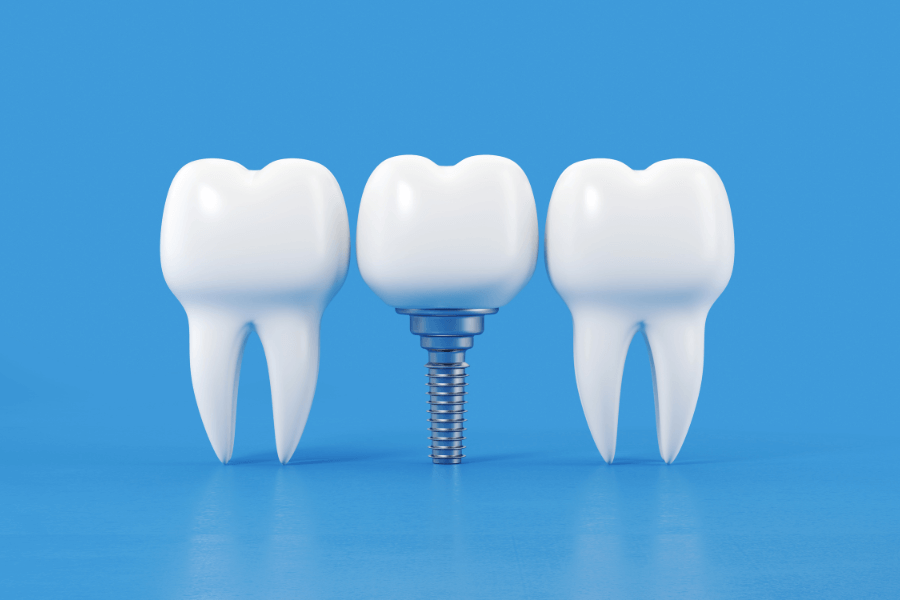 Tooth Implants in Webster: How Implants Contribute to Oral Health