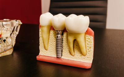 Are Tooth Implants in Webster the Right Choice for You?