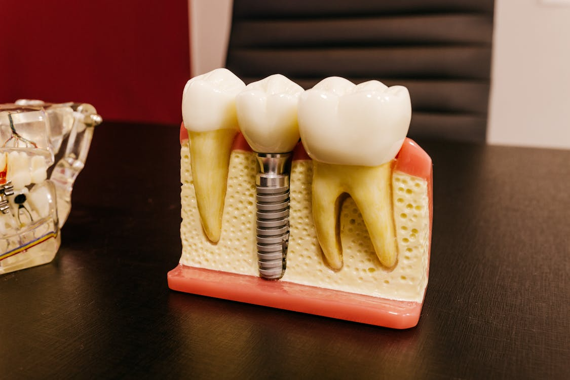 Tooth Implants in Webster Tooth Implants in Webster