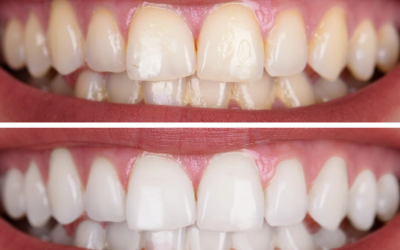 The Truth About Natural Tooth Whitening: What Really Works?