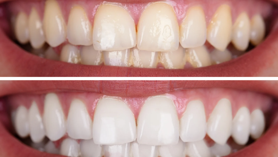 Natural Tooth Whitening
