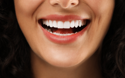 Porcelain Veneers in Webster: When Are They the Right Choice?