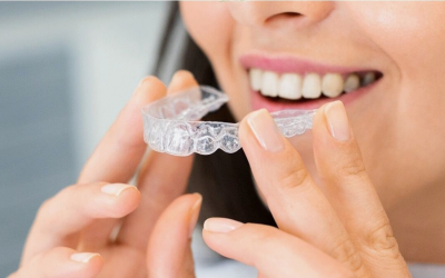 Custom Mouthguards in Webster: Who Needs One and Why?